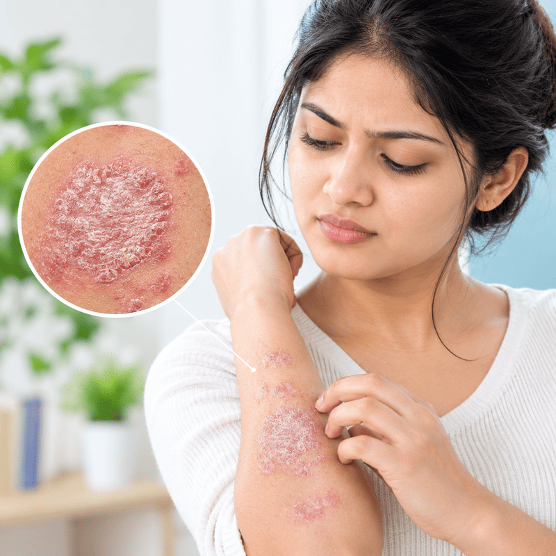 Psoriasis